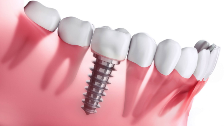 Dental implants - El Paso, TX - Valley Dental Care