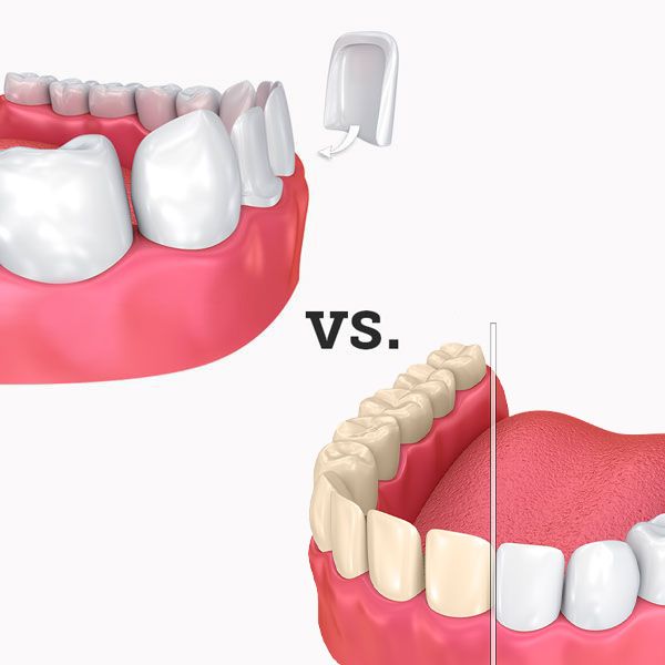 Is a Dental Veneer the Right Dental Treatment for Me?