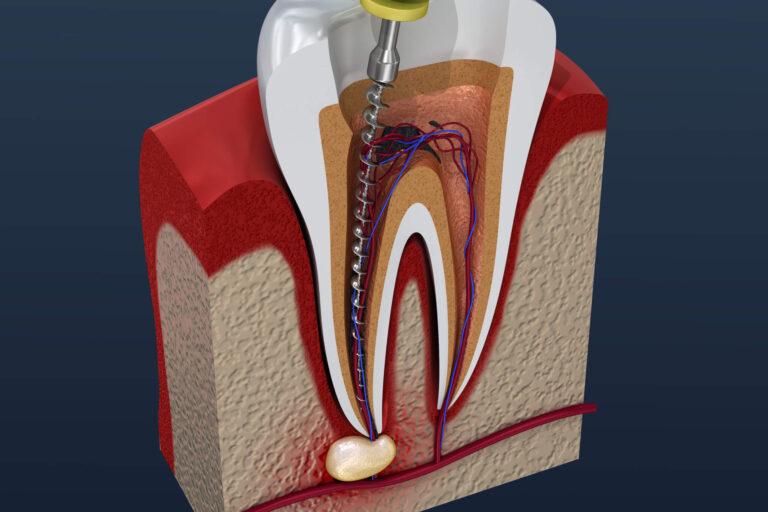 Root Canal Treatment: Everything You Need to Know