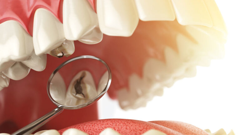 Why You Should Be Concerned with Tooth Decay