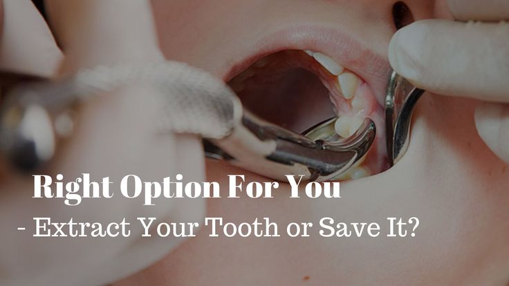 Tooth Extraction | Root Canal | Dental Crown | Dental Implant - El Paso, TX Dentist