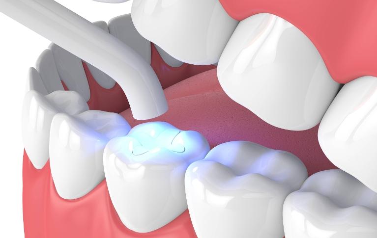 Dental Fillings - El Paso, TX - Tooth-Colored Dental Fillings: Facts & Benefits